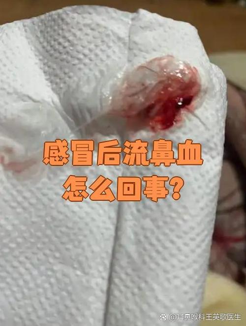 什么病毒感染会引起流鼻血