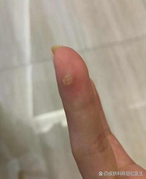 手指上长了个硬疙瘩图标