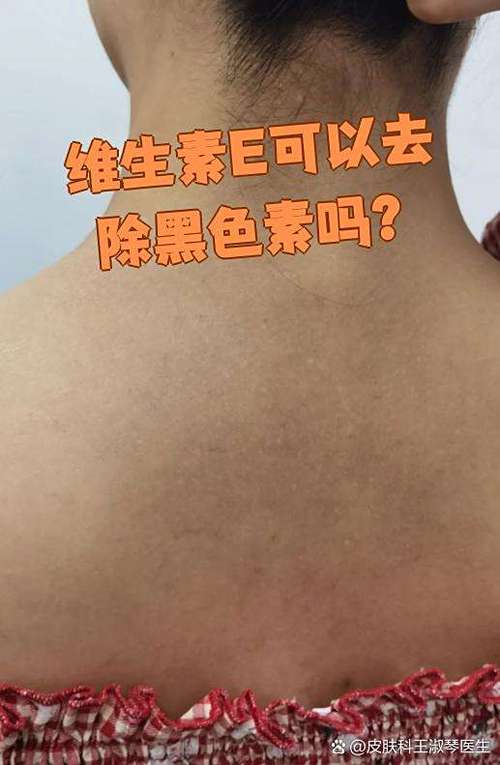 疤黑色素怎样淡化