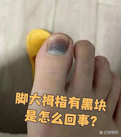 5种脚趾发黑图片