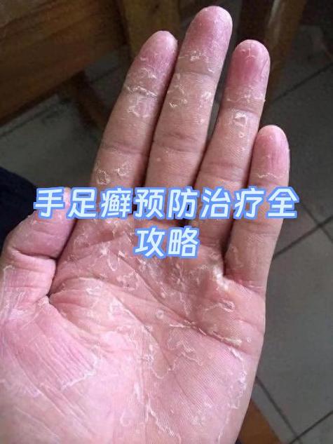 手脚真菌感染怎么根治图标
