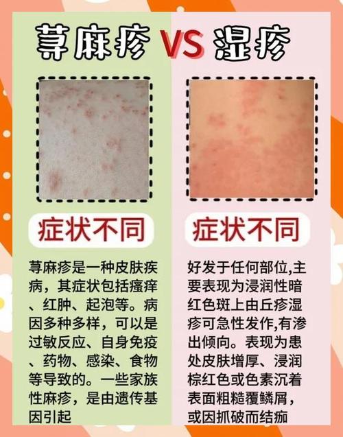 皮肤荨麻疹怎么治疗能除根图标