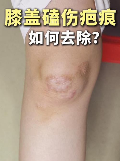 腿上摔跤留了疤痕怎么去除图标