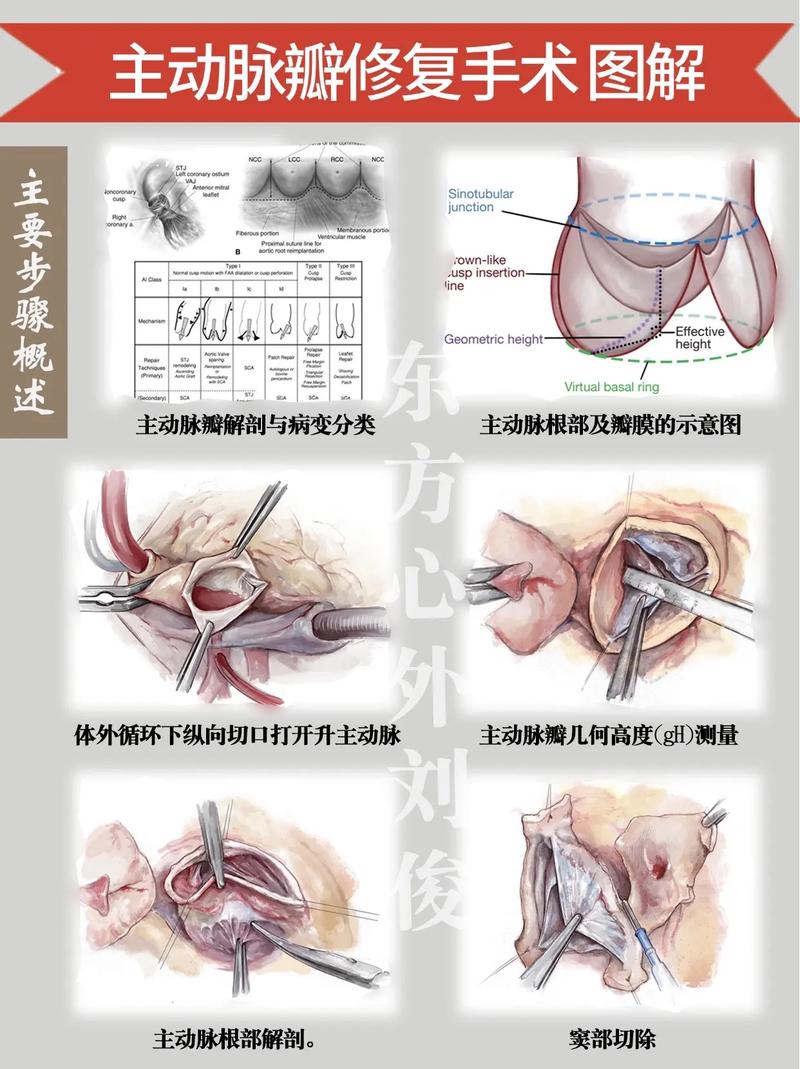 心脏瓣膜修复原理图标