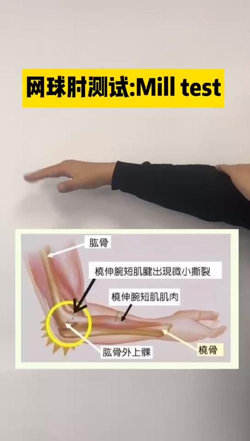 网球肘mills征图标