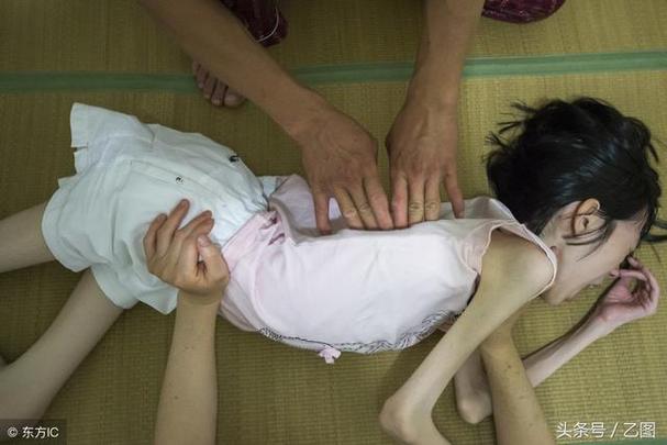 女孩怪病全身长骨头