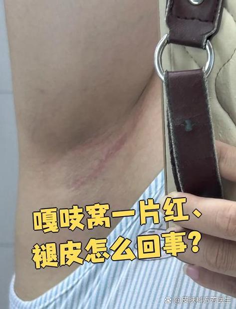 嘎吱窝特别痒还脱皮图标