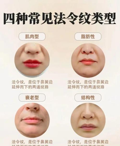 法令纹怎么解决效果最佳