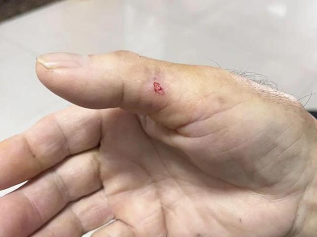 被仓鼠咬了一口