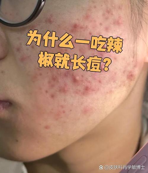 为啥吃辣痘痘就消了图标