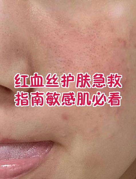 红血丝皮肤用什么护肤品最好