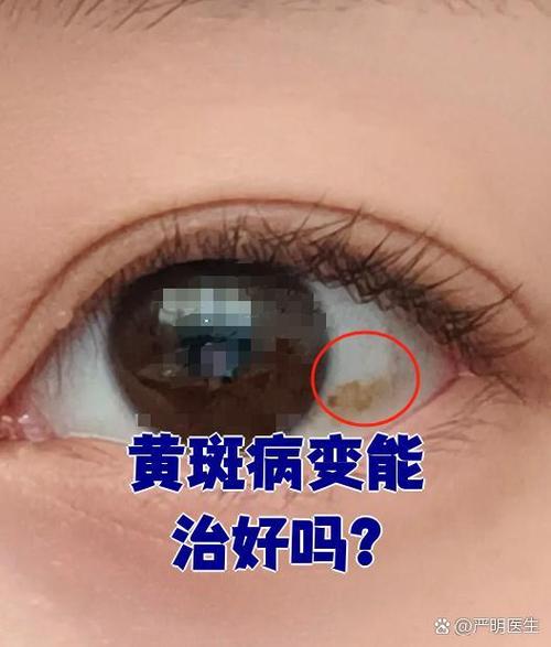 眼睛里的黄斑能消除吗图标