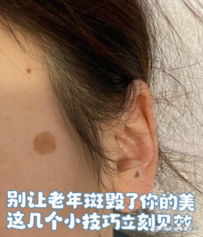 脸部色素沉着小妙招