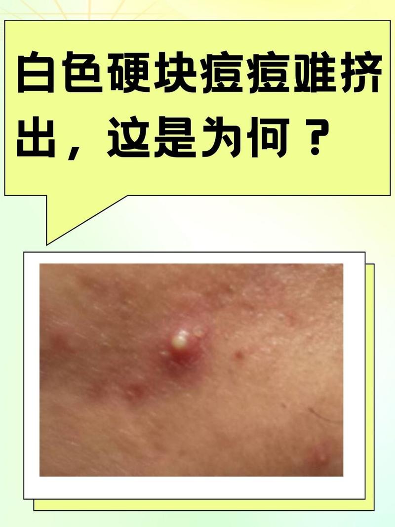 痘痘消了留下白色凸起图标