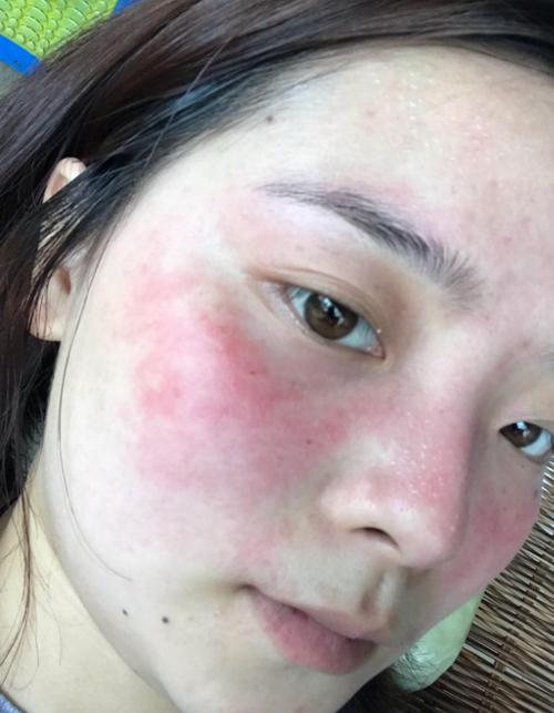 脸上皮肤薄是什么原因