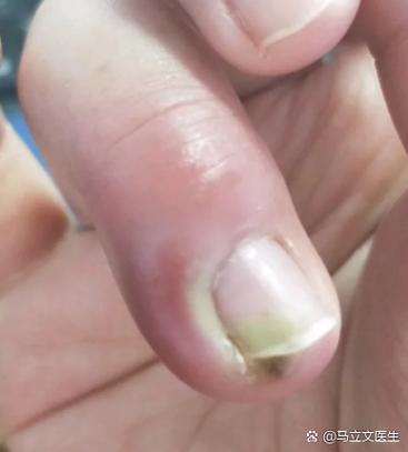 手指甲肿了怎么消肿