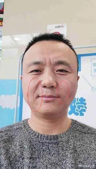 法令纹一边长一边短详解