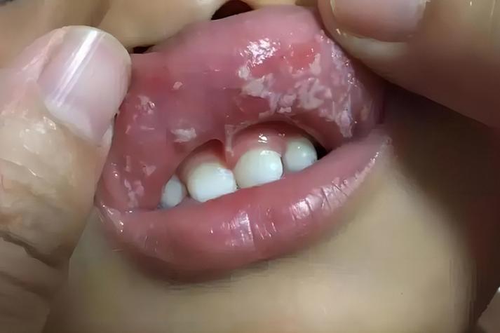鹅口疮症状图片大全图标