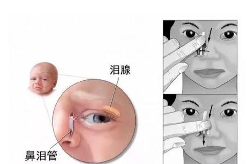 儿童眼睛流清水要警惕图标