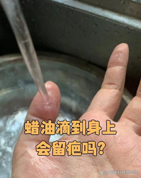 把低温蜡油滴到肛门口疼么图标