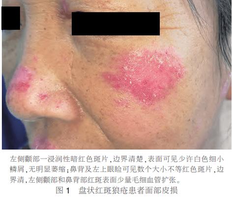 狼疮红斑早期症状图