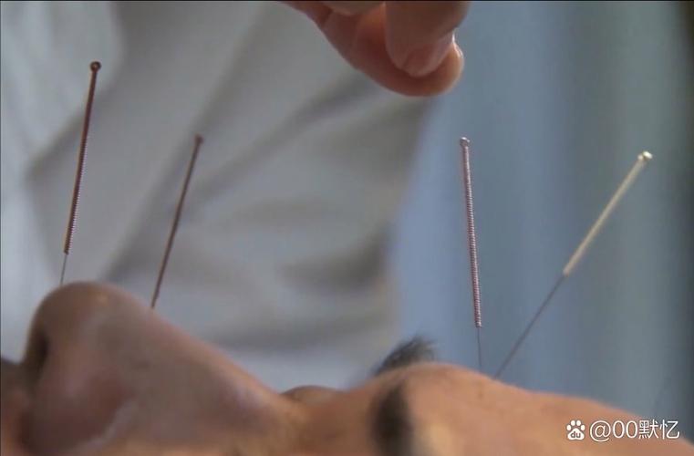 针灸临床视频1