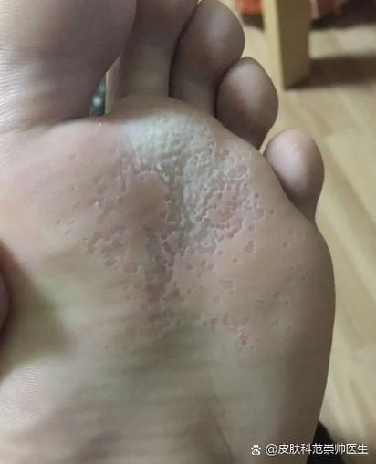 脚皮肤痒是什么原因引起的