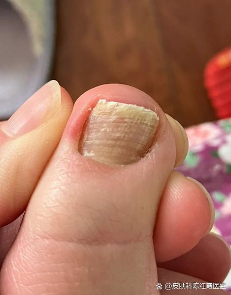 脚趾头上长了一条竖线