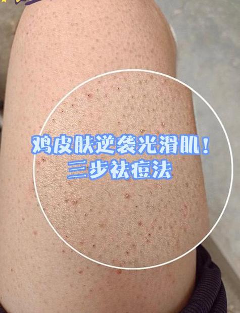 皮肤变成鸡皮肤原因