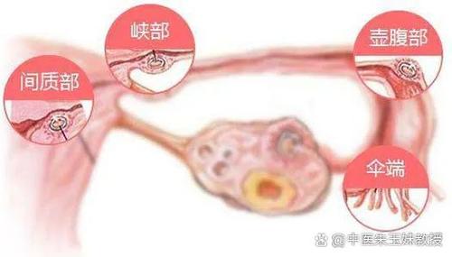 怎么自己判断输卵管是否堵塞图标