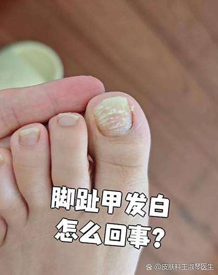 脚趾甲发白图片