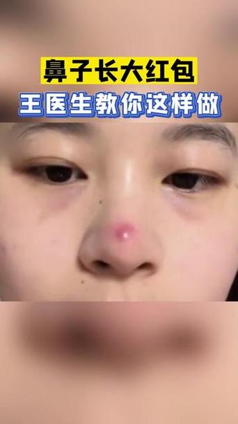 鼻头长痘红肿快速消除小妙招图标