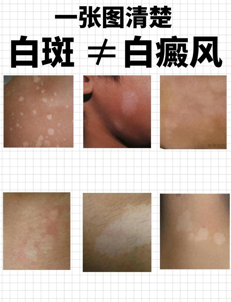 皮肤长白斑点,是什么原因引起?