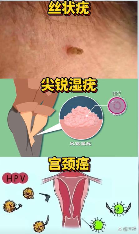 hpv病毒