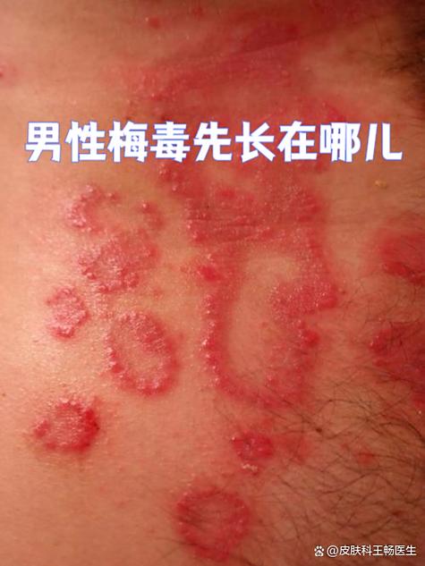 梅毒的特征照片图标