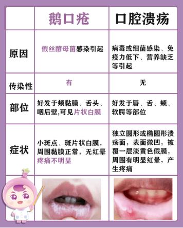 白苔与鹅口疮区分图片