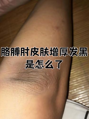 皮肤变黑是什么原因