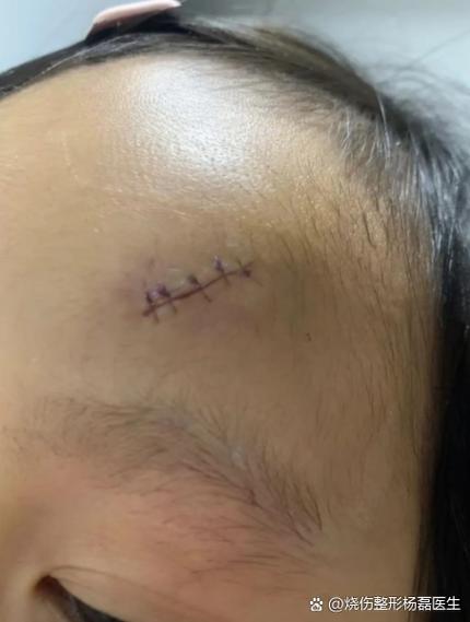 儿童面部留疤赔偿标准