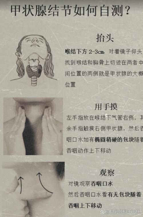 甲亢自测方法