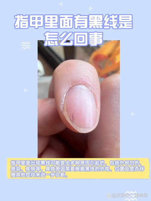 手指有黑线是什么原因图标