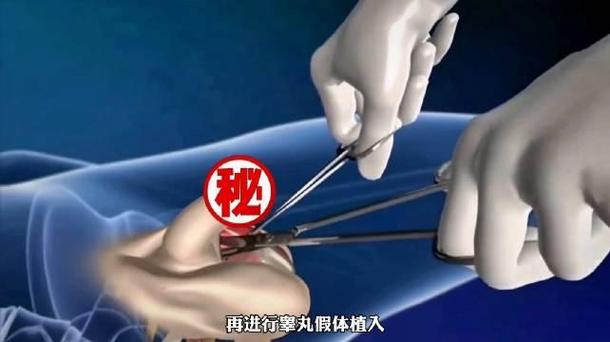 女变男手术过程3d演示