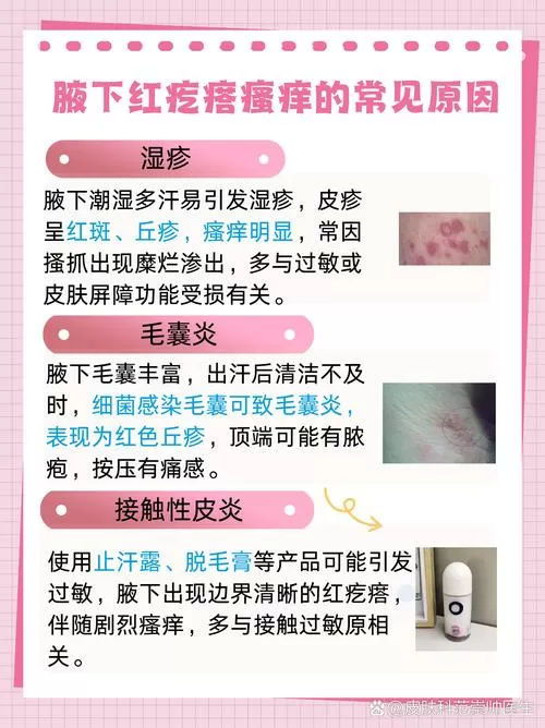 腋窝下痒痒并有小红疙瘩怎么办图标