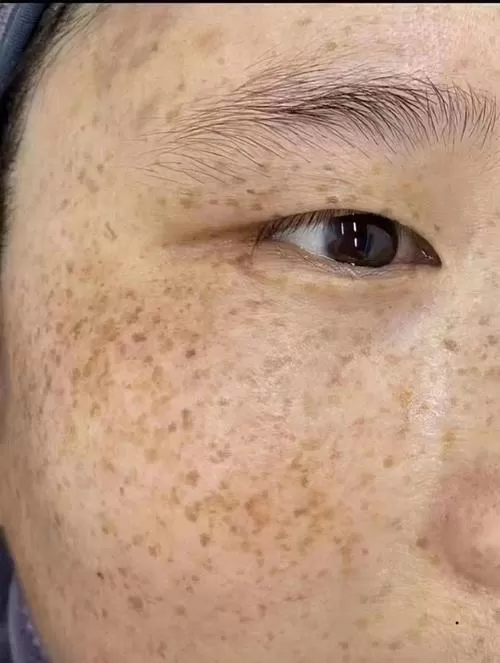 雀斑是什么样的图片图标